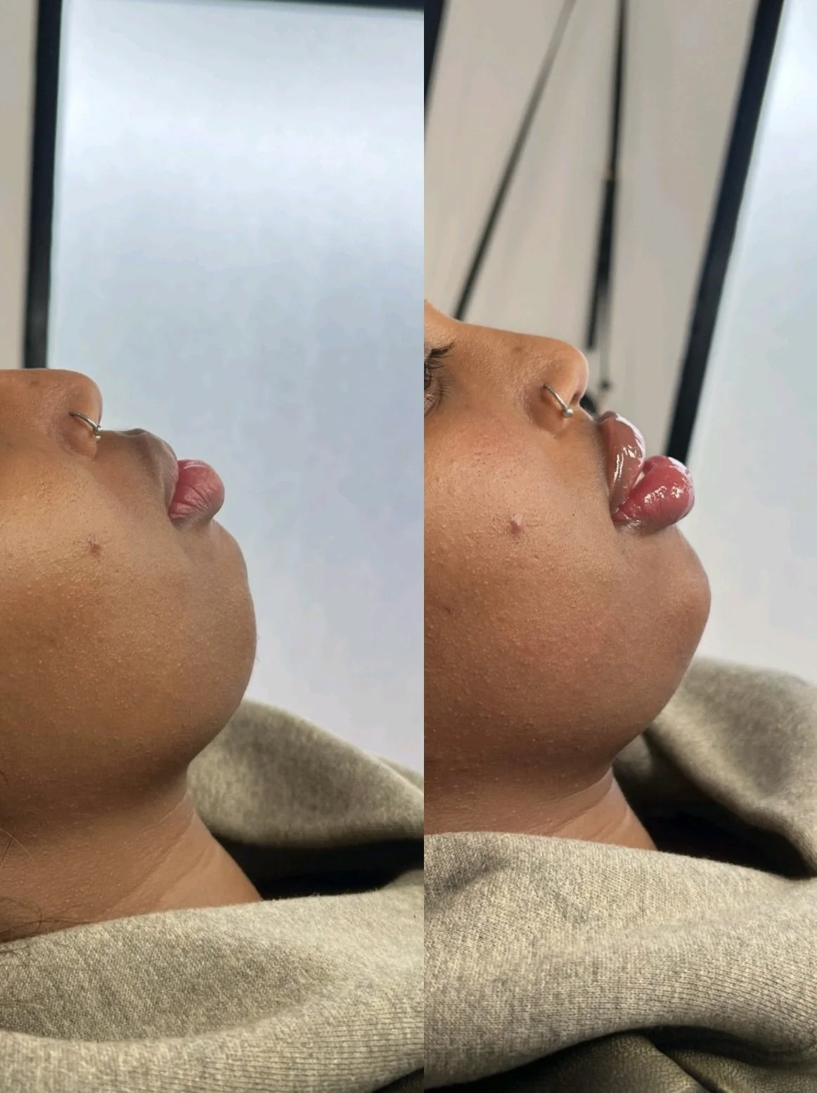 Facial Balancing 