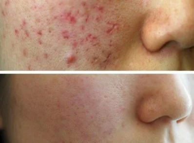 Close-up of a person's cheek showing a before and after comparison of skin with acne scars and redness, with improved skin appearance in the after image.