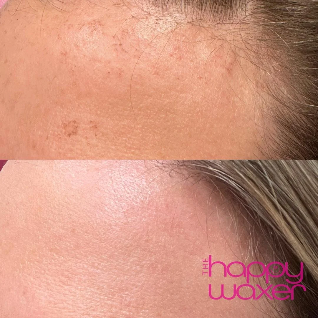 forehead before after.jpg