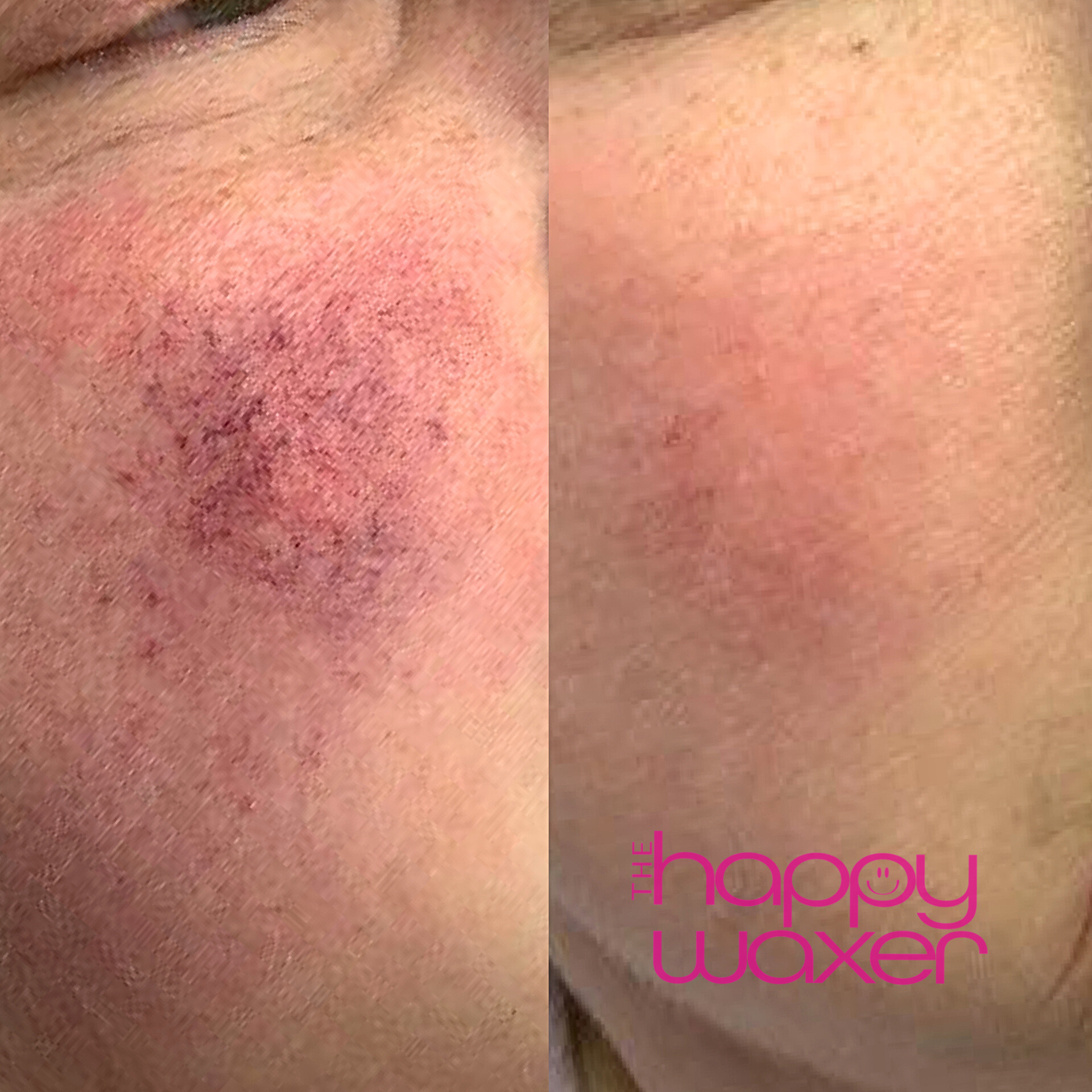 cheeks before after.png