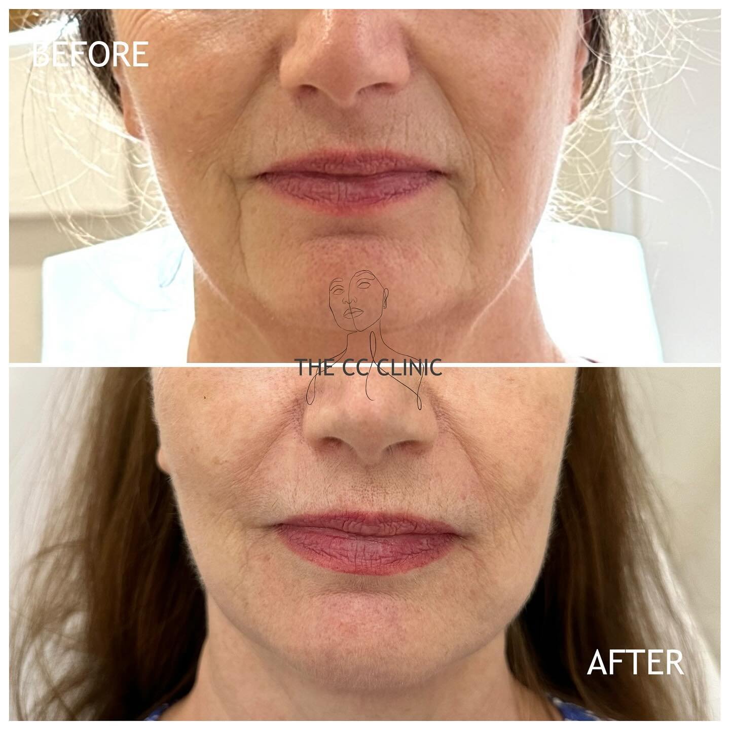 SMILE LINES 😁 
Adding 2ml of hyaluronic acid filler here has beautifully and naturally softened some deeper smile lines - giving a youthful refresh to the face 😍 This is a review after 2 weeks 

⚡️ PAIN POINT: mild-moderate 
⌚️ SOCIAL DOWNTIME: 24-