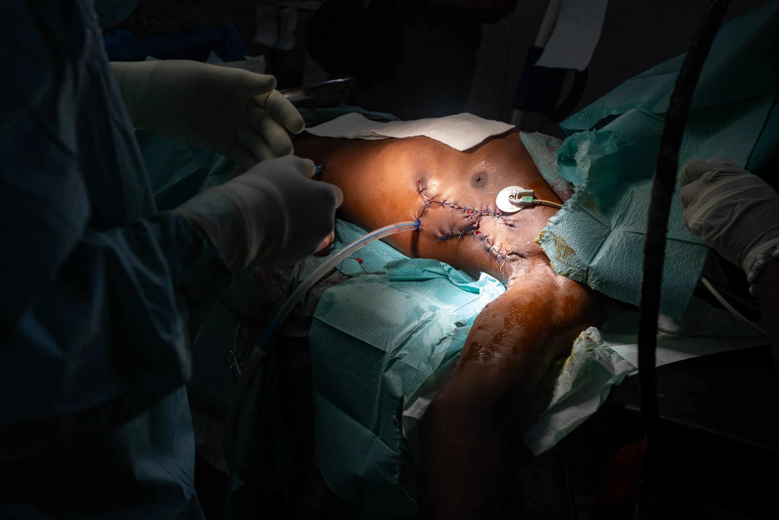 Dr. Sidibé operates on a war-wounded patient at the CBCA Ndosho hospital in Goma, managed by the ICRC. 63% of war injuries are civilians. Goma, DRC, February 11, 2025.