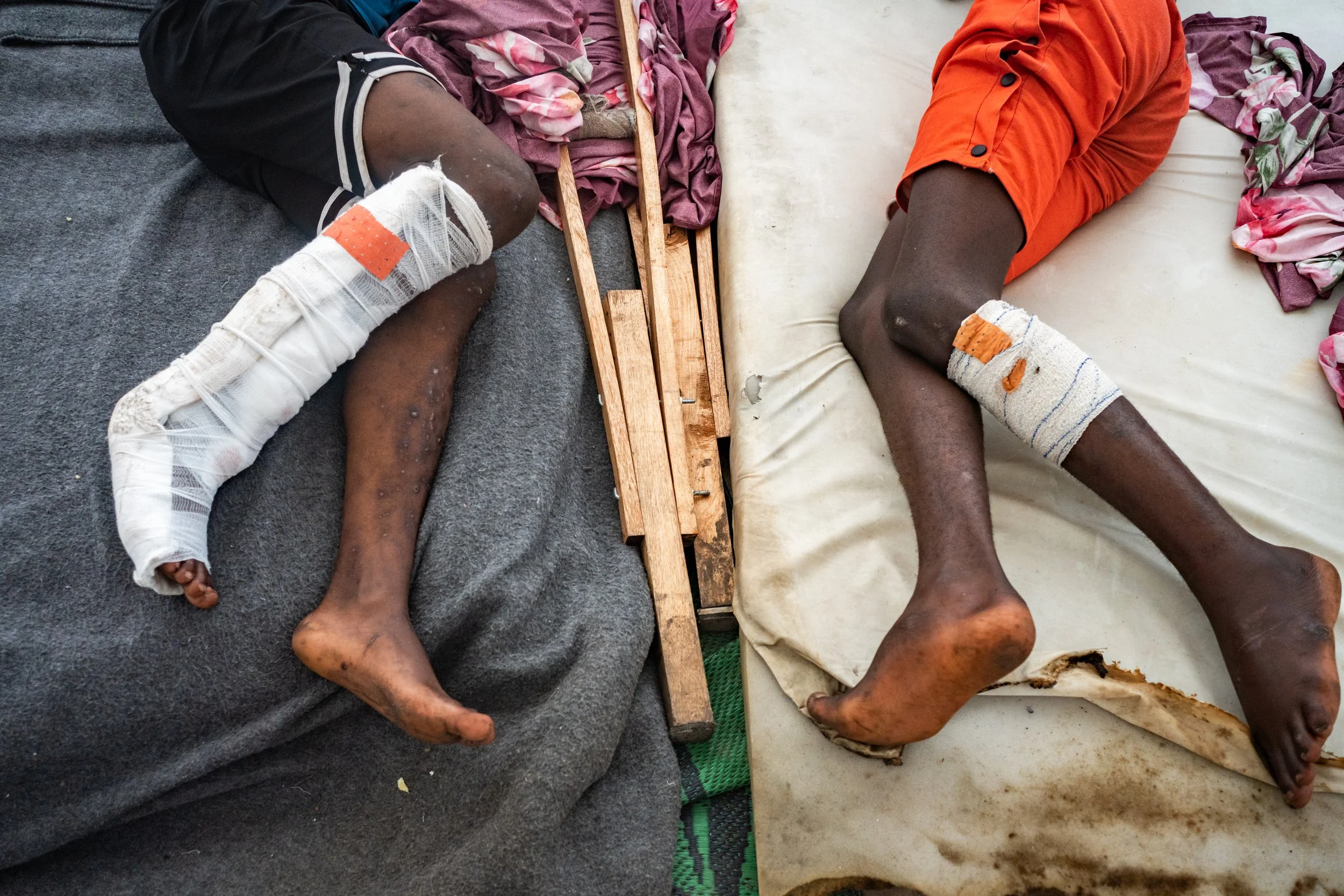 At the Ndosho hospital in Goma, managed by the ICRC, 67% of war-wounded patients are civilians, including 20% women and 12% children under 15. Goma, February 11, 2025.