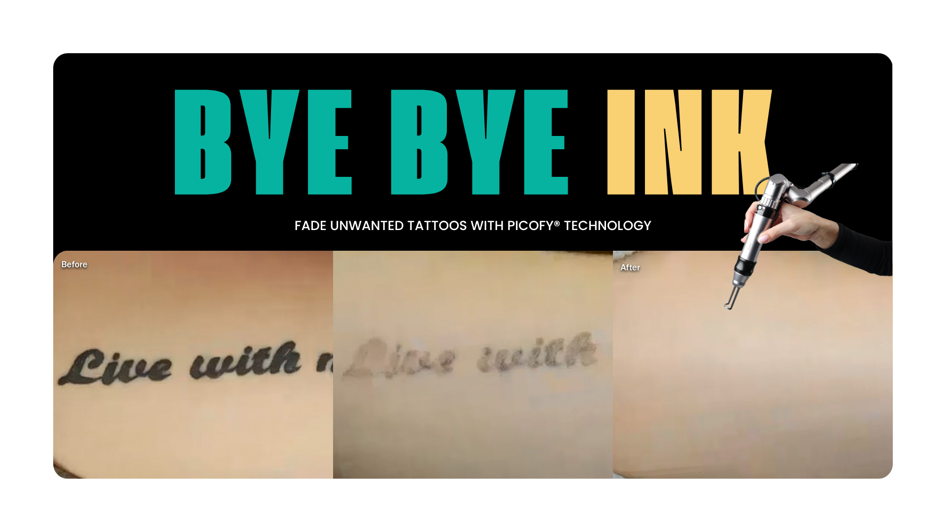 Rejuvenate Wellness, Picofy, ultra-short pulses, pigment, picosecond, pigmentation, skin tone, acne scarring, tattoos, tattoo removal, north shore, elite wellness