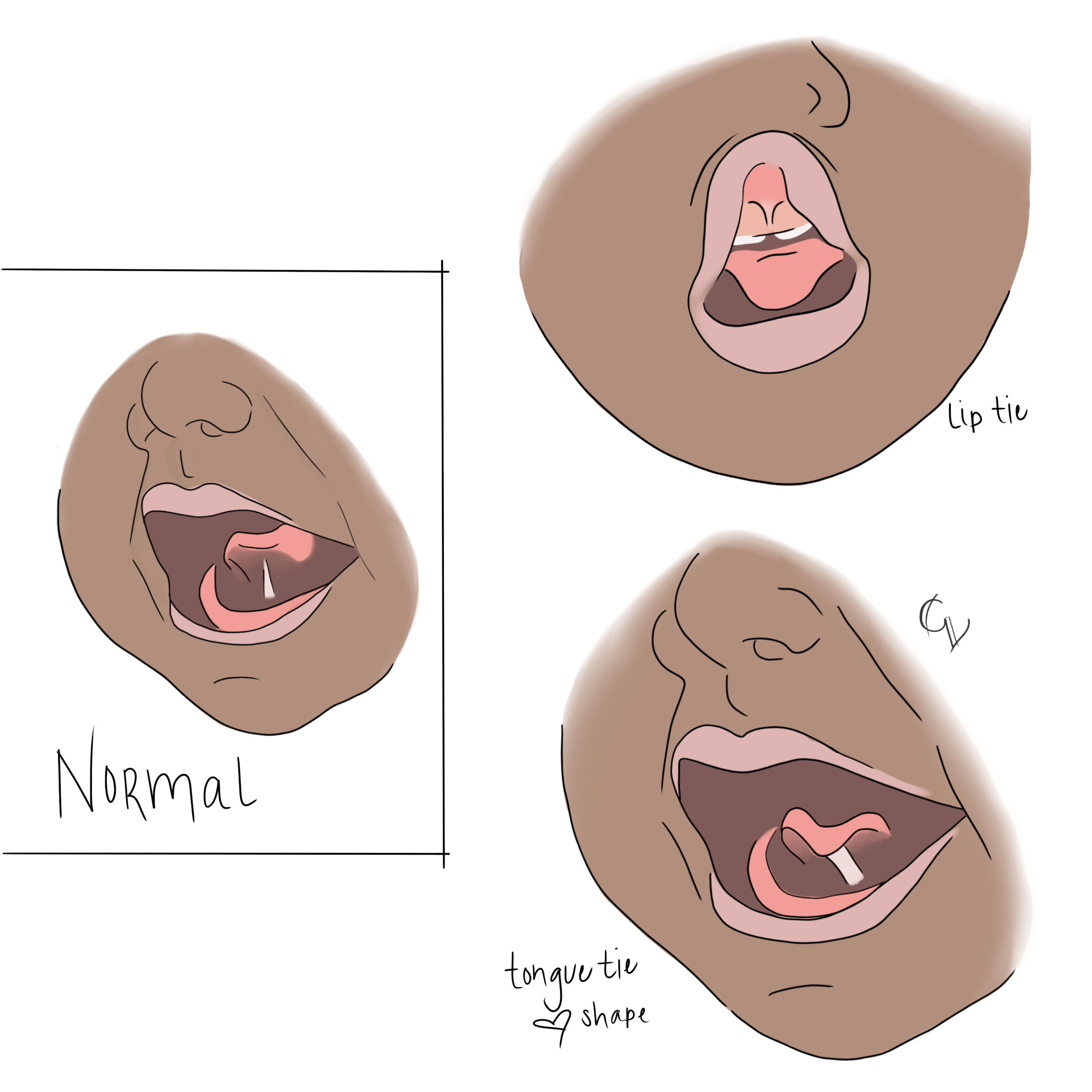 Tongue and lip ties illustration