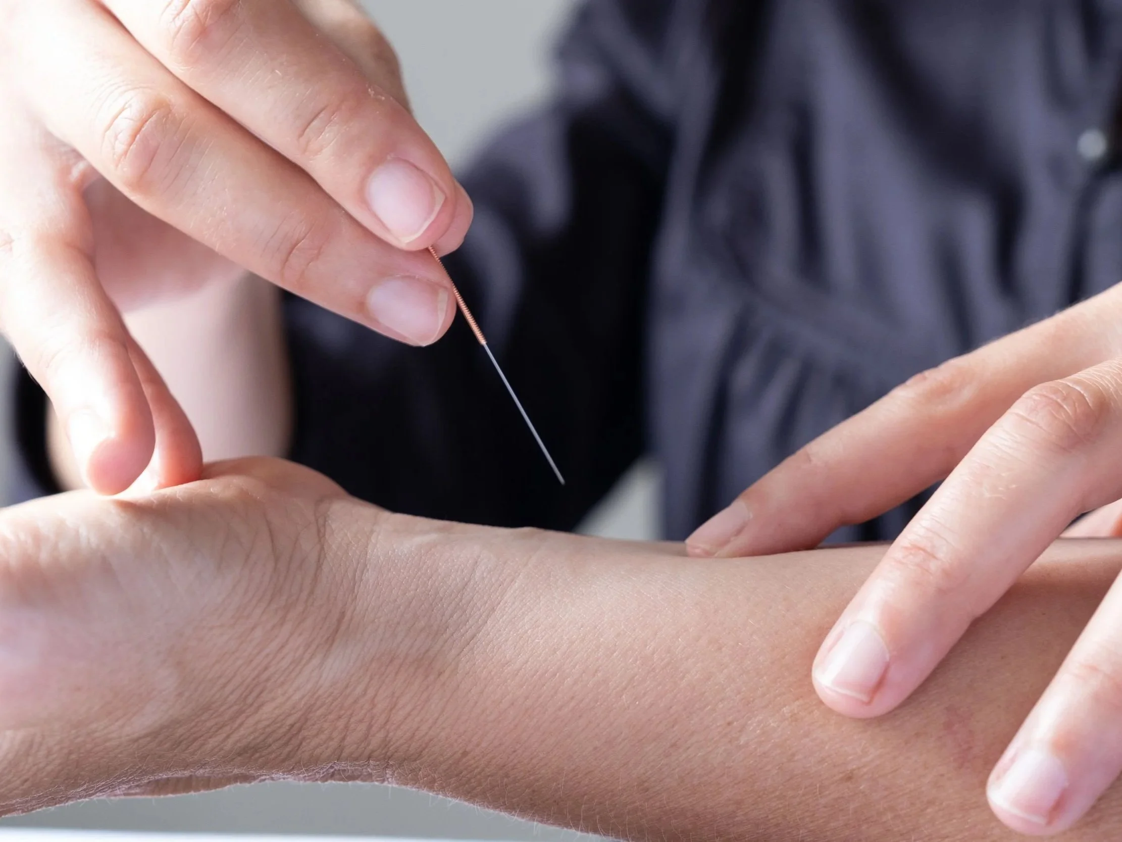 Does Acupuncture Hurt?