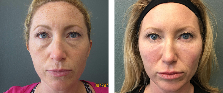 anti_aging_institute_juvederm_thumbnails03.png