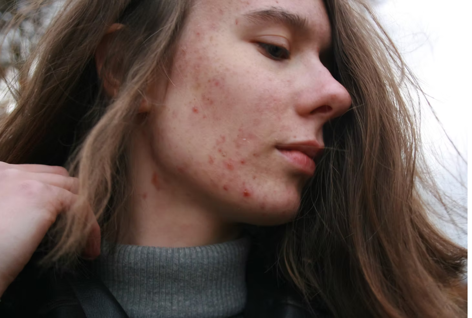 How Functional Medicine Helps Clear Persistent Acne from the Inside Out
