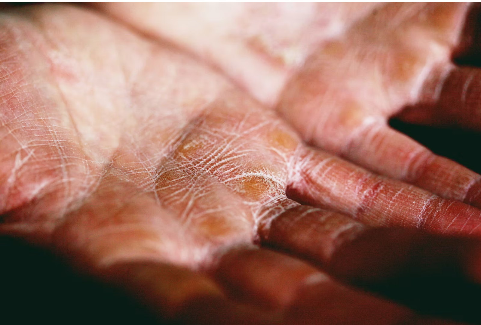 Eczema &amp; Functional Medicine: Understanding the Root Causes and Natural Relief