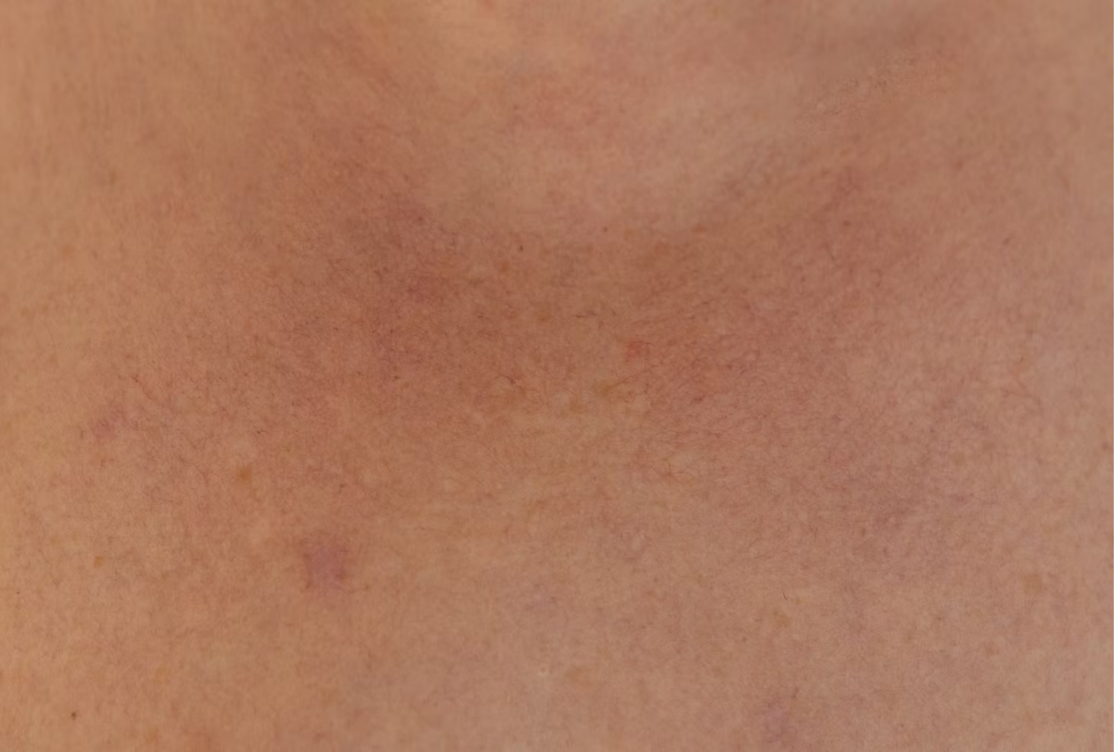 Rosacea: Why Your Skin Is Flushing (and How Functional Medicine Can Help)