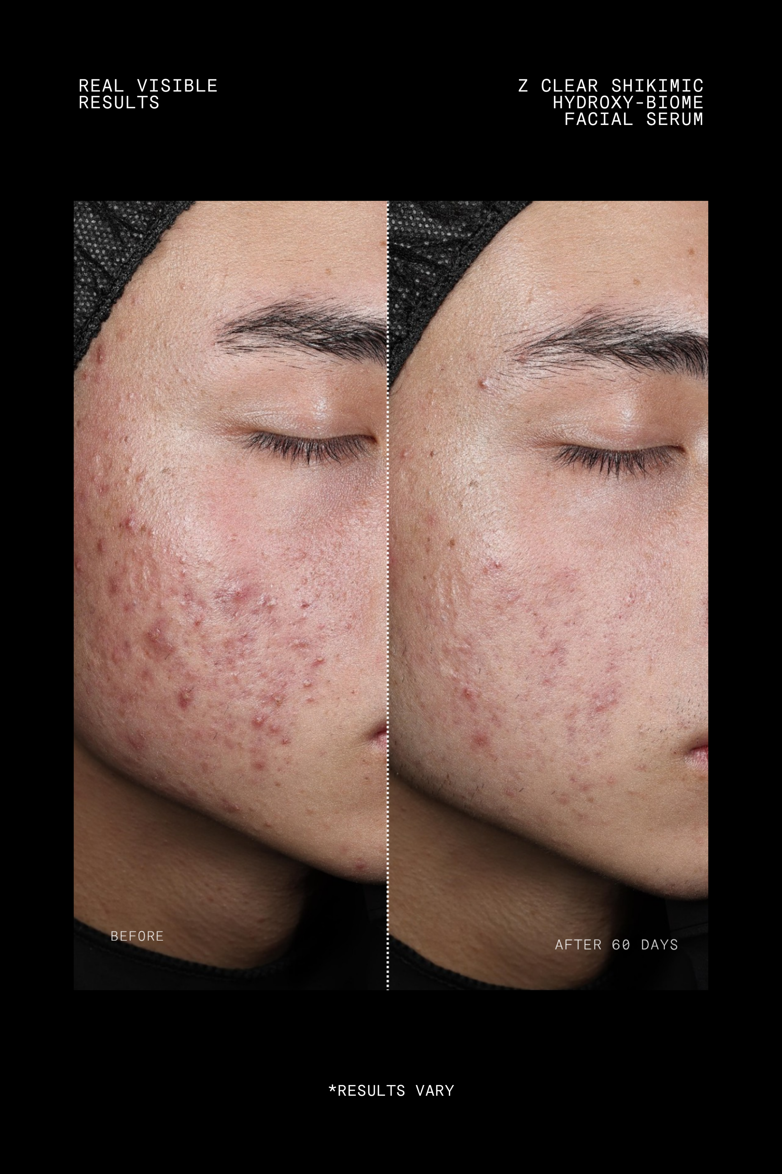 FTP-N511-030_Z Clear Shikimic Hydroxy-Biome Facial Serum_Before-After.png