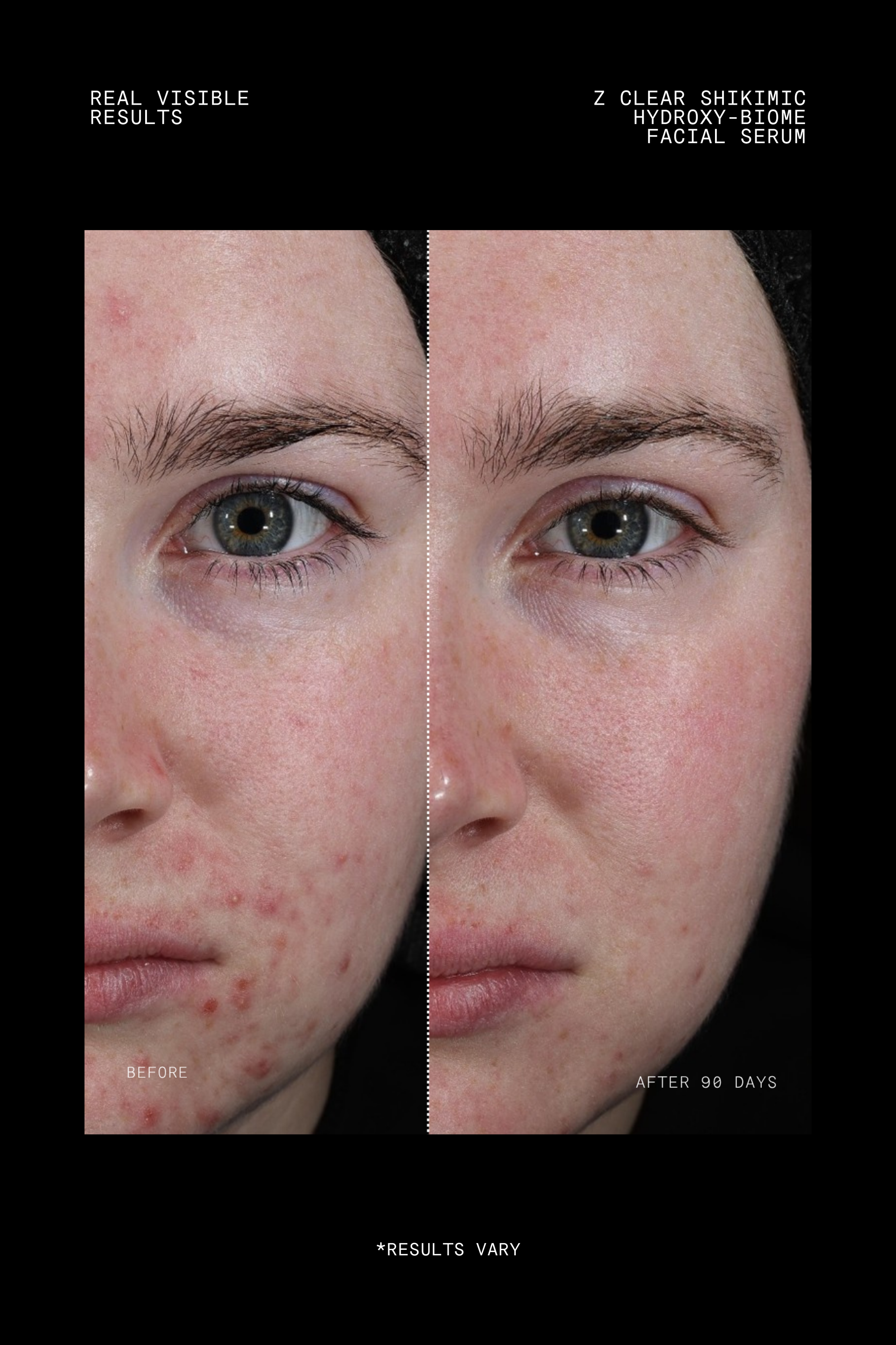 FTP-N511-030_Z Clear Shikimic Hydroxy-Biome Facial Serum_Before-After-2.png