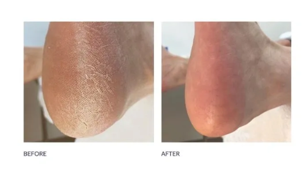 footlogix before after.png