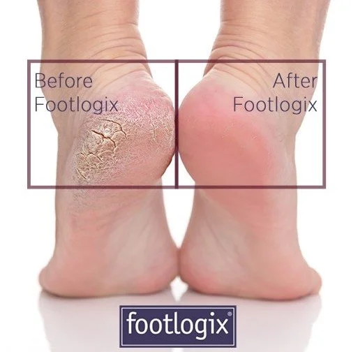 Footlogix Before & After square.jpg