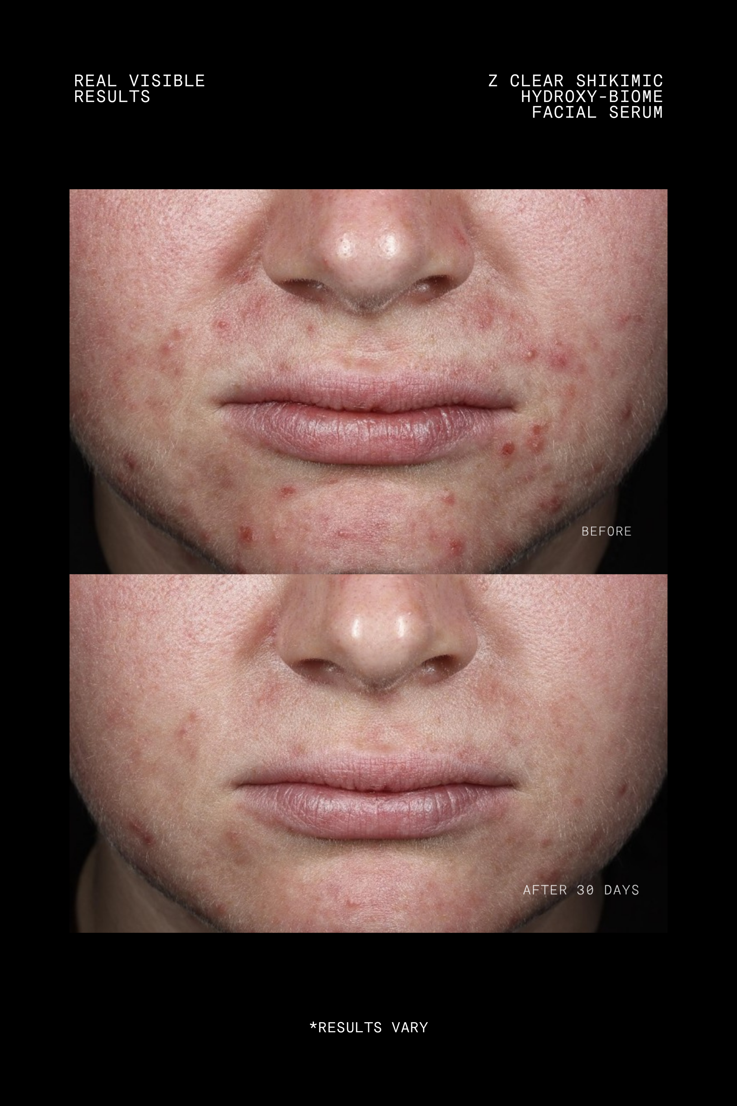 FTP-N511-030_Z Clear Shikimic Hydroxy-Biome Facial Serum_Before-After-3.png
