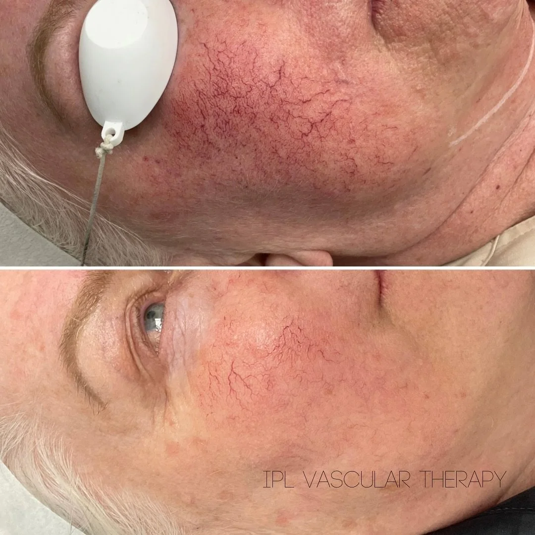 Visible veins on the face - like broken capillaries and and redness are more common than you think! 🤔
.
.
.
.
Common causes of vascular veins can include: 

- sun exposure 
- skin trauma
- ageing 
- rosacea 

These vascular veins can be effectively 