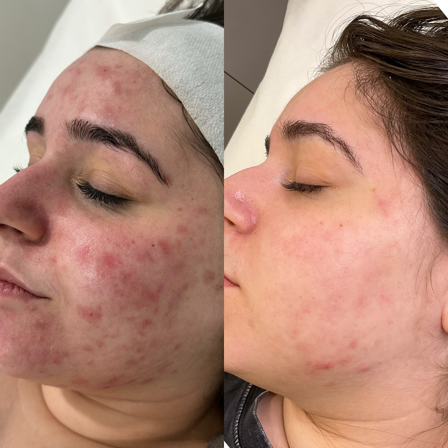 Microneedling results in just 3 sessions!! 🤯😍
.
.
.
.
For our lovely client Amber, we have been treating her concerns with breakouts, redness and acne scarring. Amber purchased a 3 session bundle of microneedling that includes a full session of LED