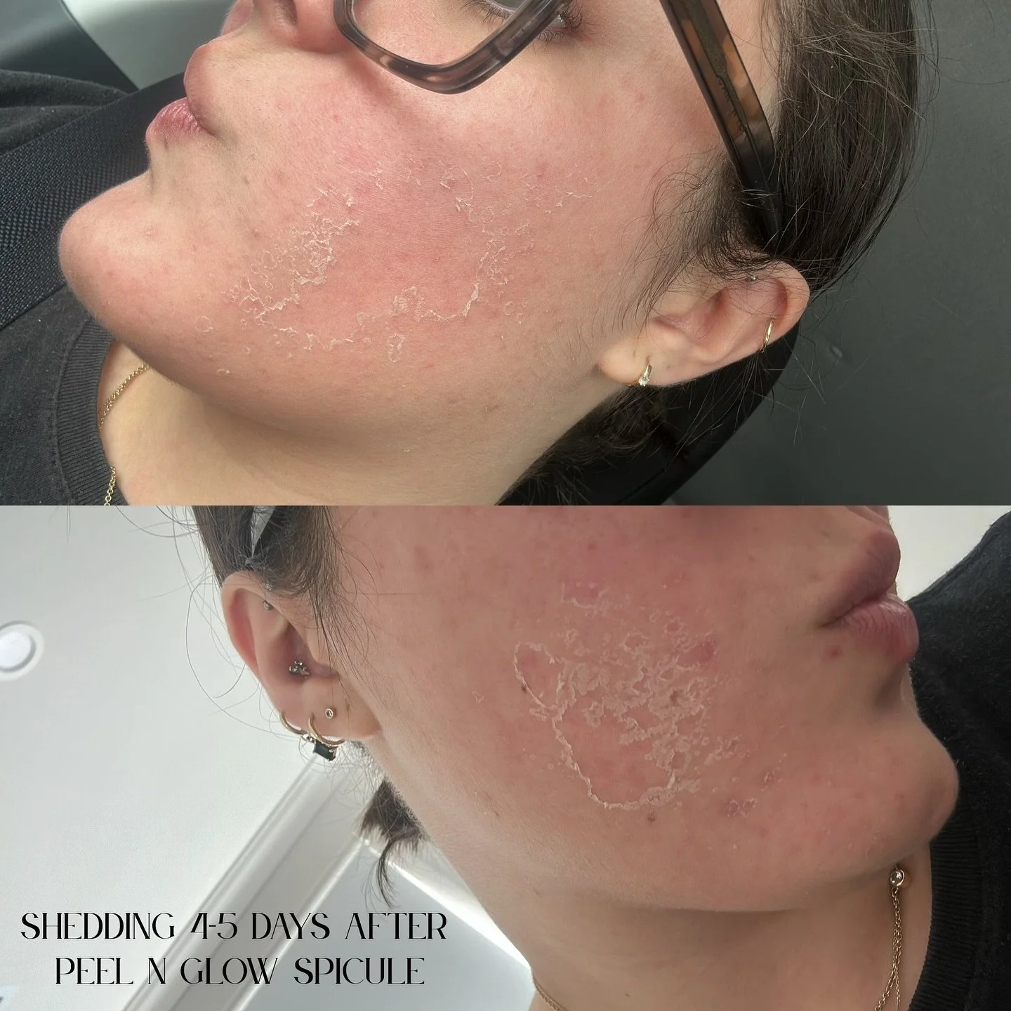Wondering why our skin sheds after our new Korean spicule treatment? 🤯
.
.
.
.
After this facial, the skin sheds because the treatment uses microscopic spicules (tiny needle like structures derived from marine sponges) that gently penetrate the skin