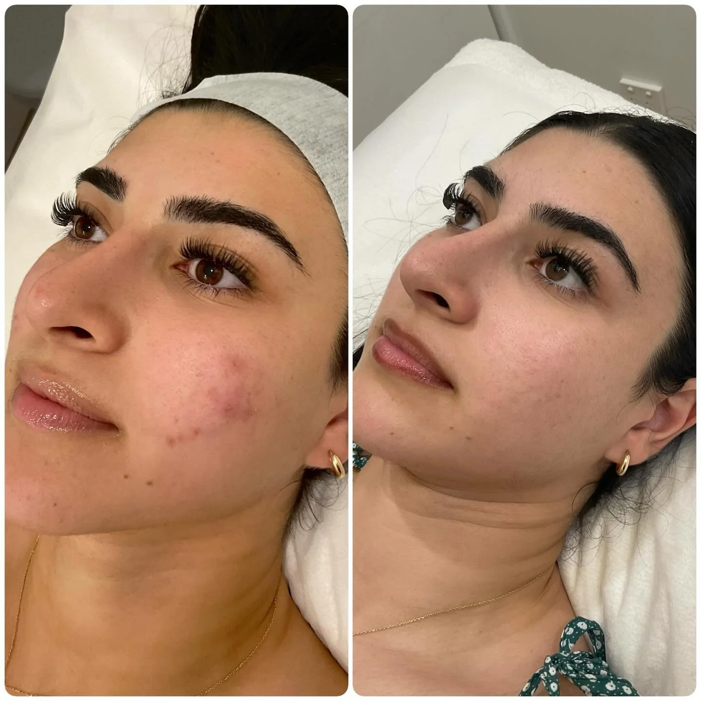 6 microneedling sessions in and her skin is glowing!!✨
.
.
.
.
Fewer breakouts, smoother texture, and an overall brighter, healthier complexion. We paired each treatment with red + green LED, and the consistency truly paid off. So proud of her result