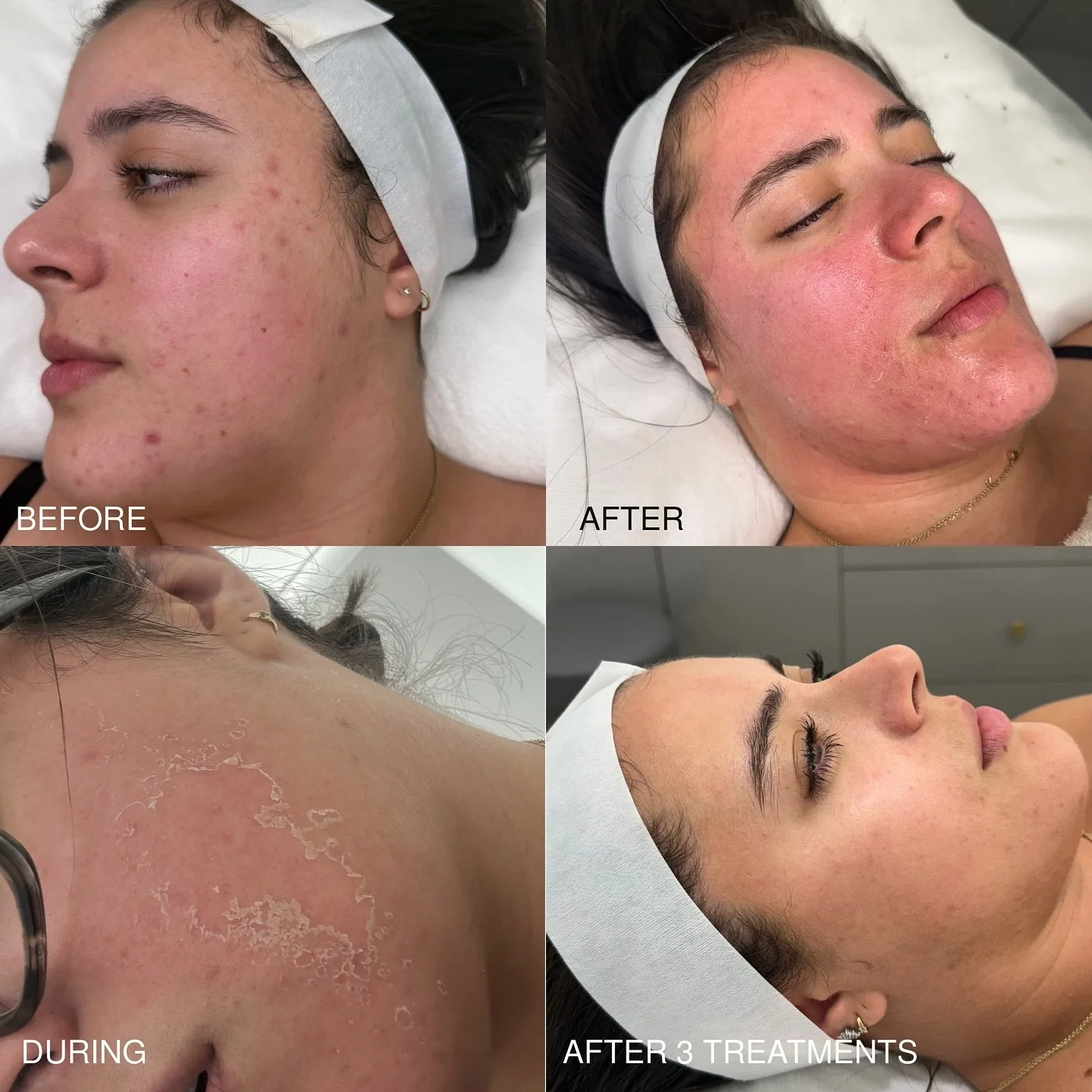 Real results. Real skin. Real consistency ✨
.
.
.

These photos show our client&rsquo;s journey:
➡️ Before treatment
➡️ Directly after
➡️ 4&ndash;5 days post-treatment (during the healing + renewal phase)
➡️ After 3 sessions of our Peel N Glow Korean