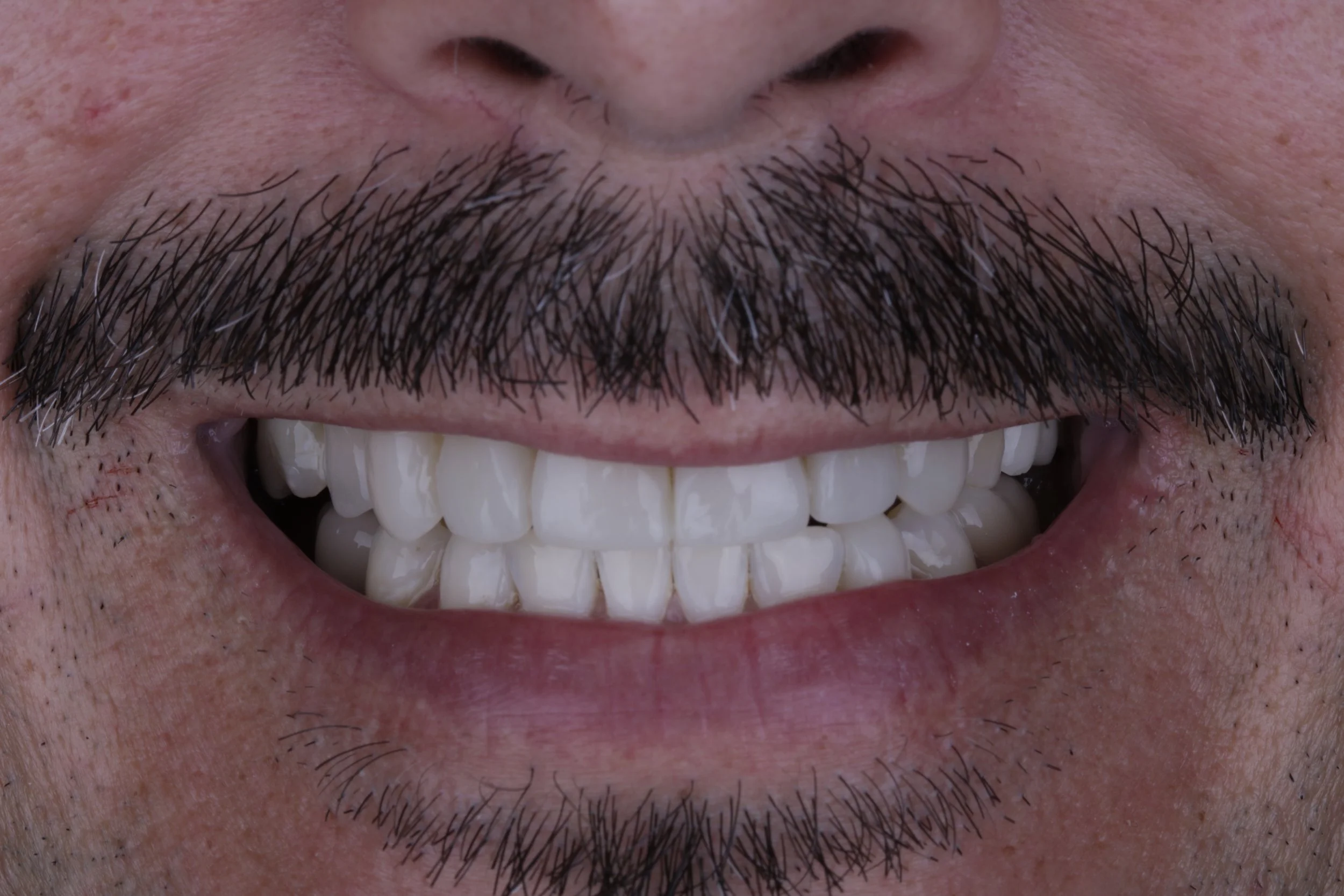 Close-up of a smile showing white teeth, dark facial hair, and parts of the nose and chin.