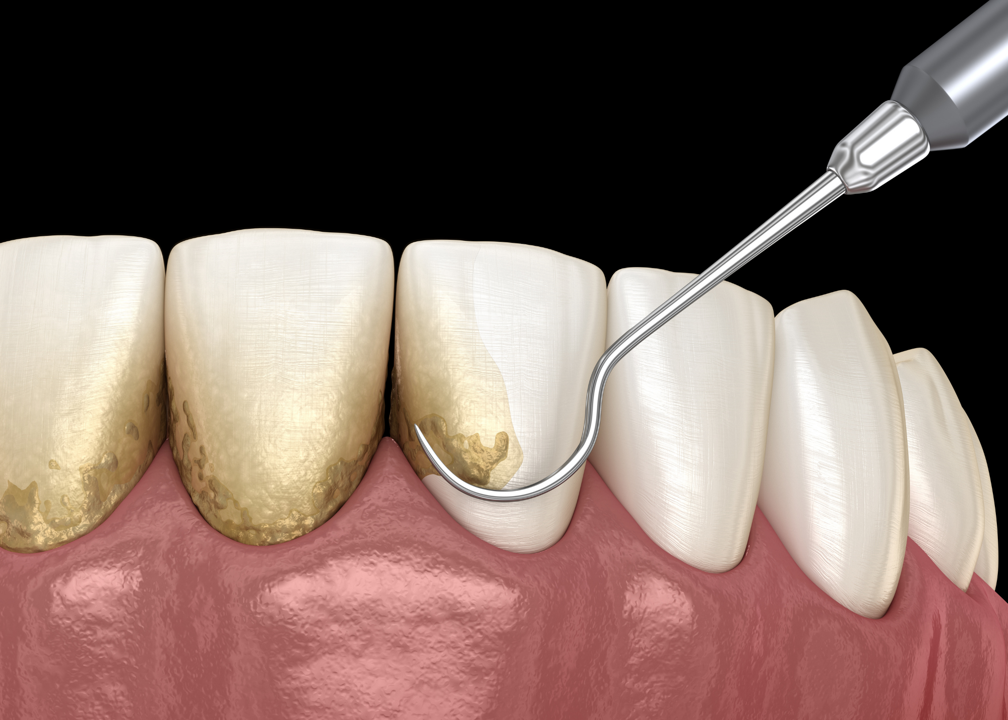 Close-up illustration of teeth with plaque buildup, showing a dental tool cleaning the teeth.