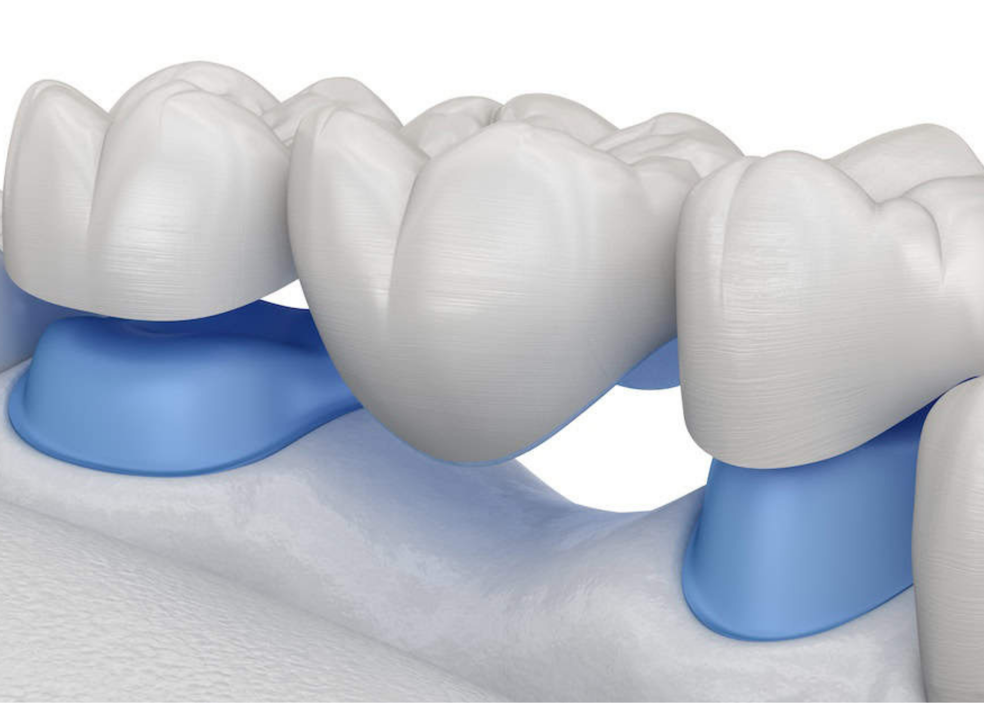 Close-up image of multiple human molar teeth with dental crowns or restorations, set against a blue background.
