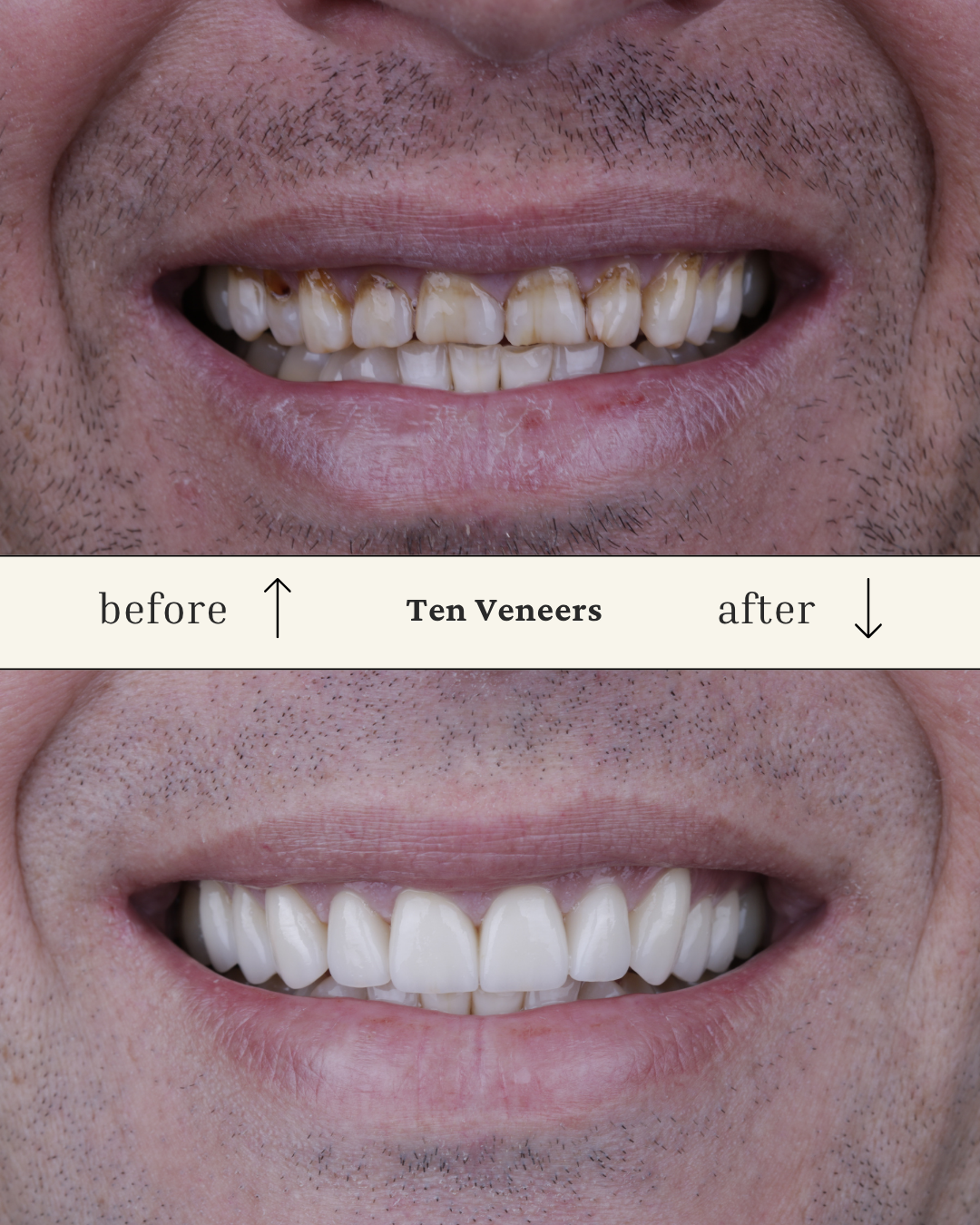 Comparison of teeth before and after dental veneers, showing improved color and alignment.