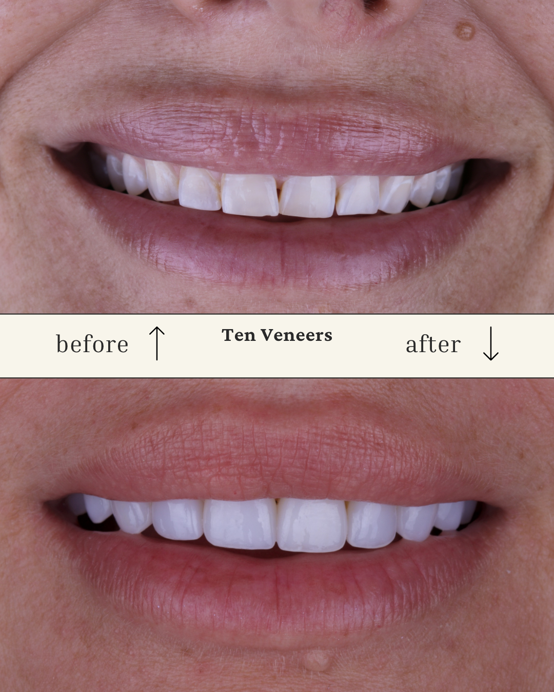Comparison of teeth before and after getting ten prepless veneer, showing improved appearance and uniformity.