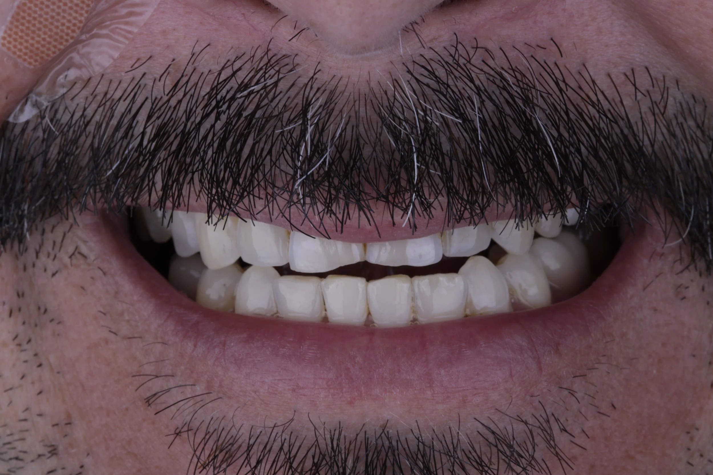 Close-up of a smiling person's mouth showing upper and lower teeth, beard, and mustache with visible skin texture.