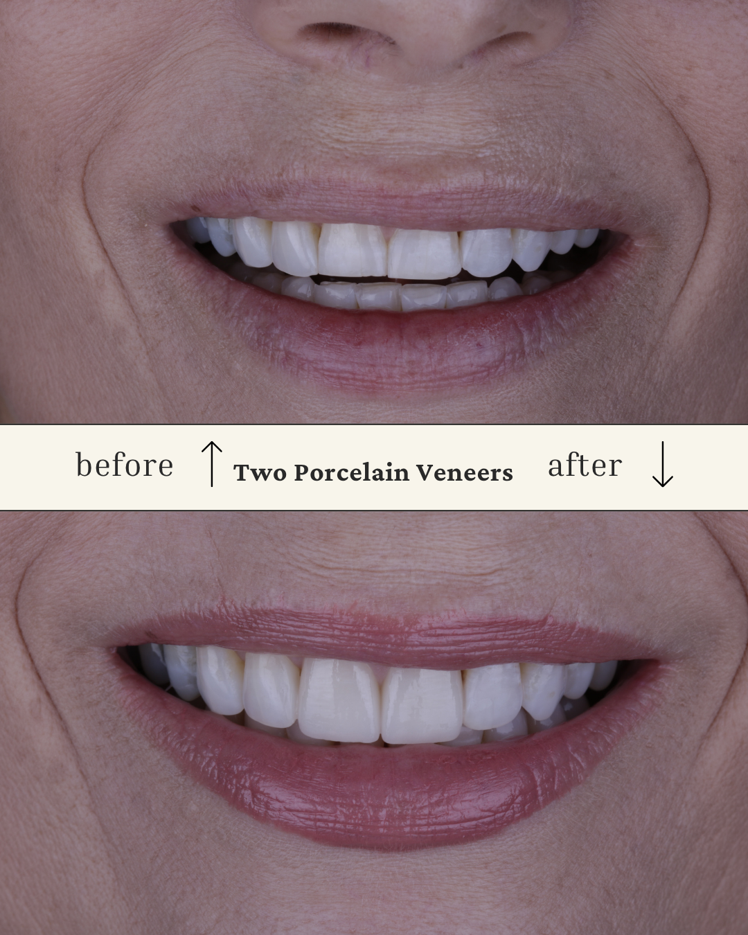 Close-up of a smiling person's mouth before and after dental veneer application, showing improved teeth appearance with porcelain veneers.