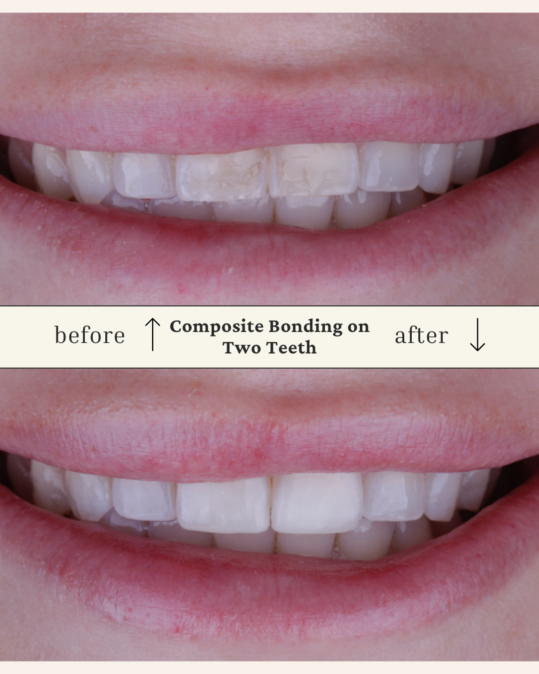 Close-up of a person's smile showing teeth before and after composite bonding on two teeth, with dental procedure labels and arrows indicating the changes.