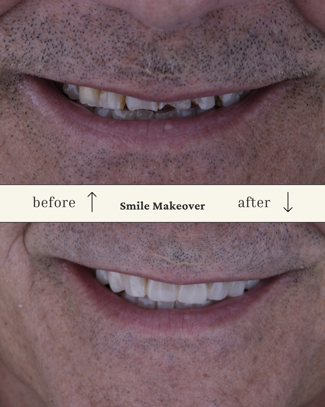 Close-up of a man's mouth showing a before and after comparison of smile makeover, highlighting improved teeth appearance in the after image.