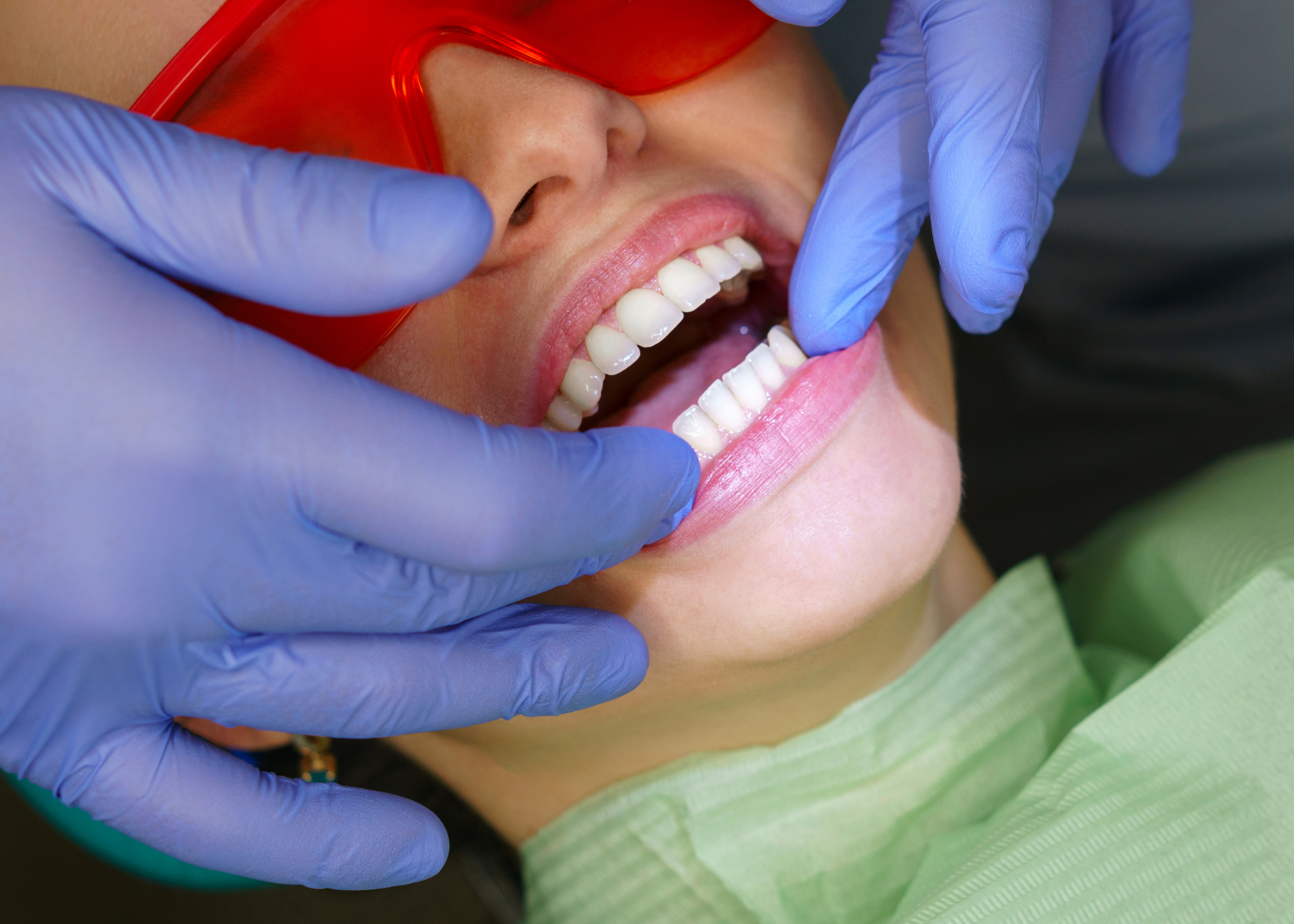 Close-up of a person lying down at the dentist, with a dental dam in place, and a dentist wearing blue gloves examining their teeth.