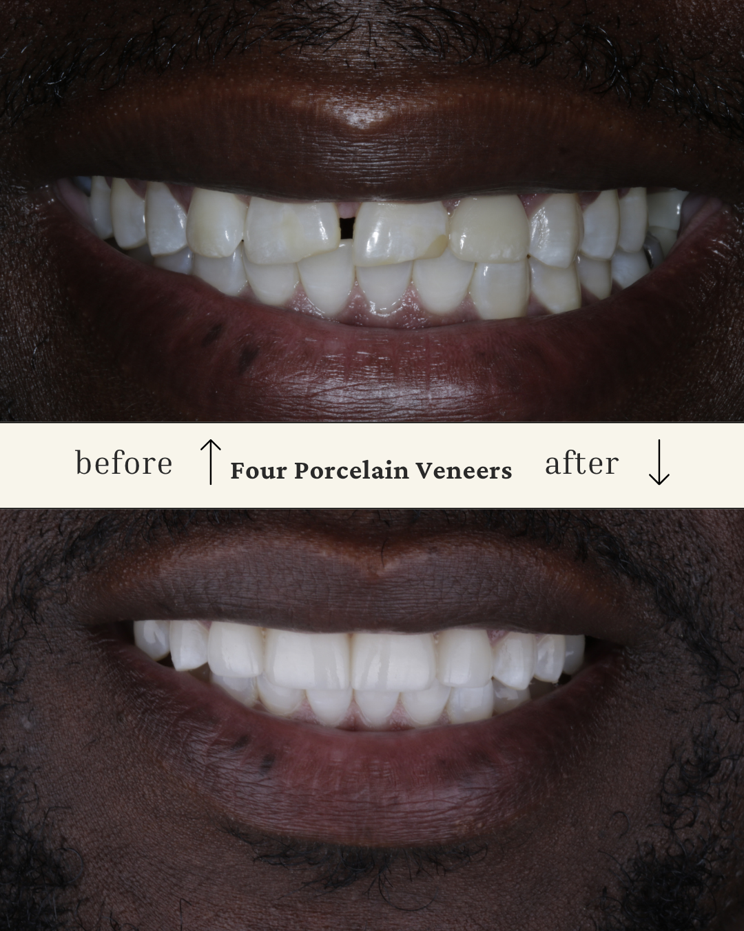 Close-up of a person's smile showing a before and after comparison of dental veneers. The before image displays chipped and uneven teeth; the after image shows a set of smooth, straight, white teeth after four porcelain veneers.