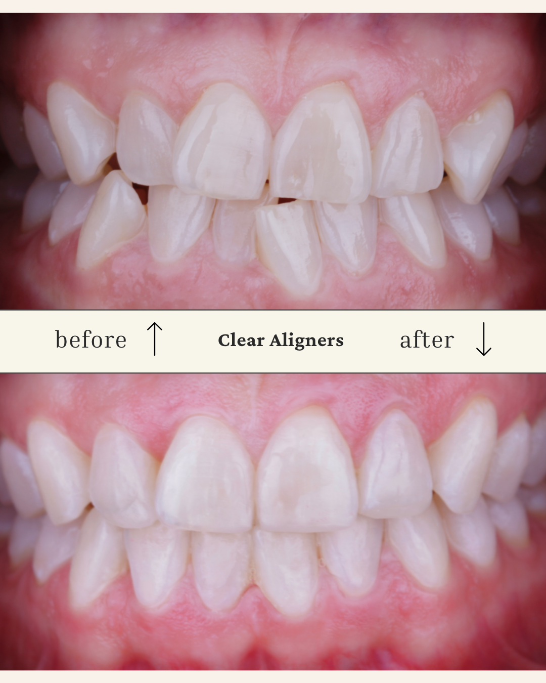 Before and after comparison of teeth alignment showing clearer, straighter teeth after using clear aligners.