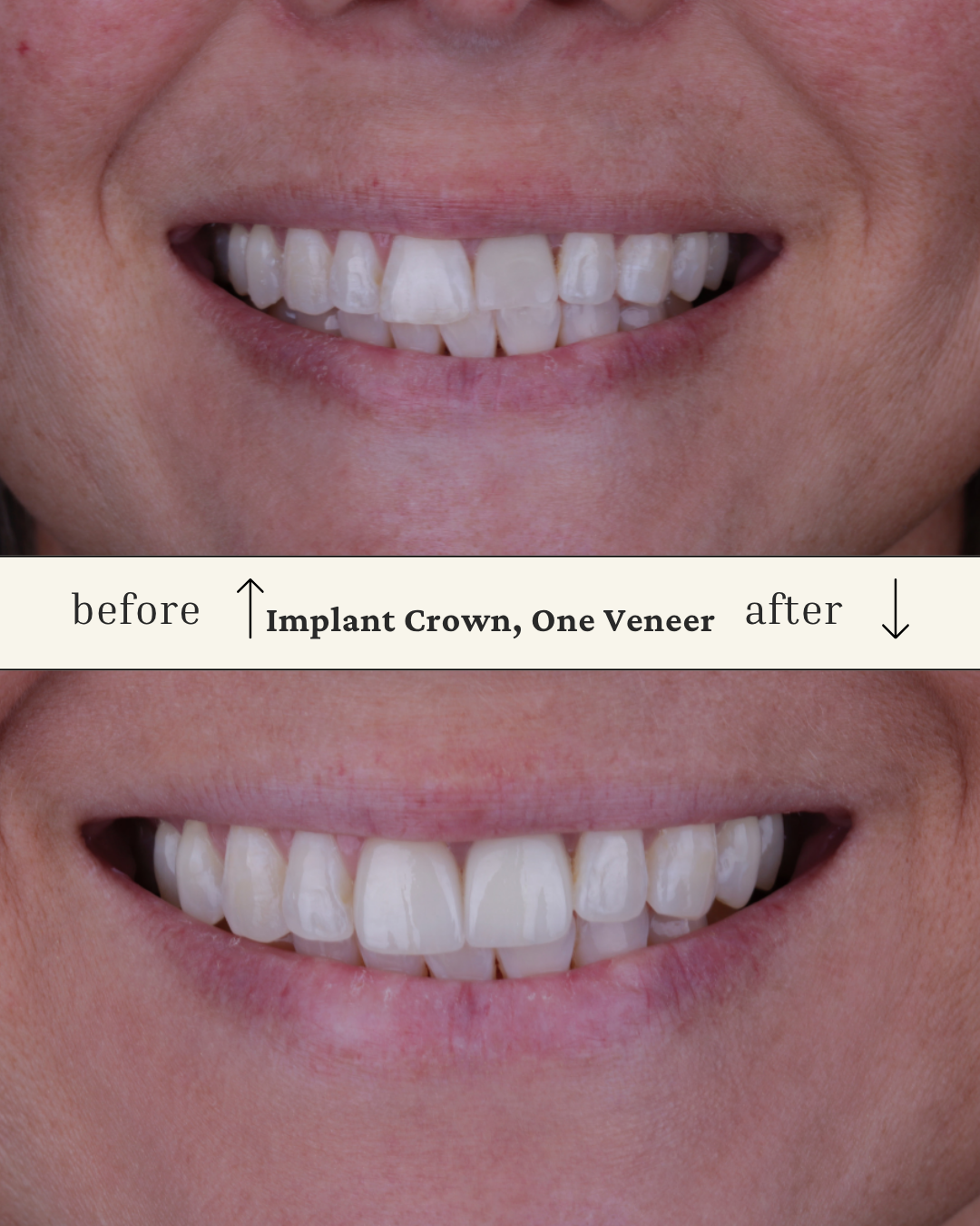 Comparison of teeth before and after implant crown and veneer; top shows teeth with uneven spacing and discoloration, bottom shows teeth that are evenly aligned and whiter.