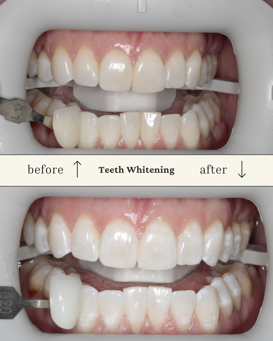 Comparison of teeth before and after whitening, showing a patient’s upper and lower teeth in a dental shade guide and whitening process.
