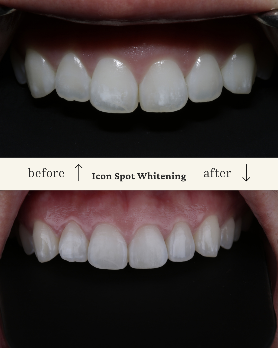 Close-up of a person's teeth showing before and after icon spot whitening, with the top image labeled 'before' and the bottom image labeled 'after'.