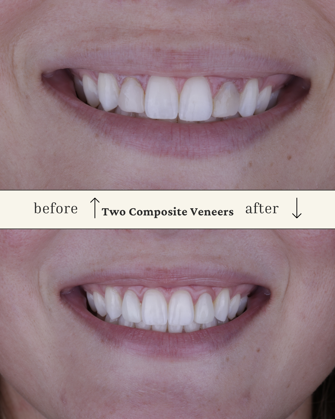 Comparison photo showing teeth before and after composite bonding with the 'before' image on top and the 'after' image on the bottom, illustrating improved tooth appearance.