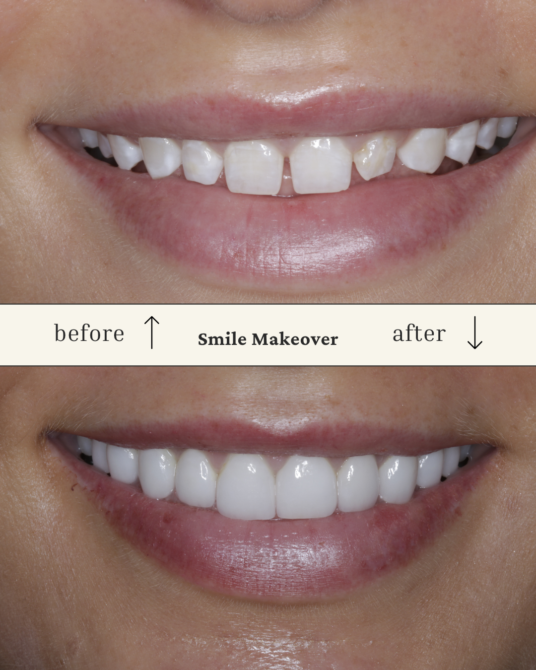 Comparison of a person's teeth and smile before and after a smile makeover with prepless veneer, showing significant improvement in whiteness and alignment.