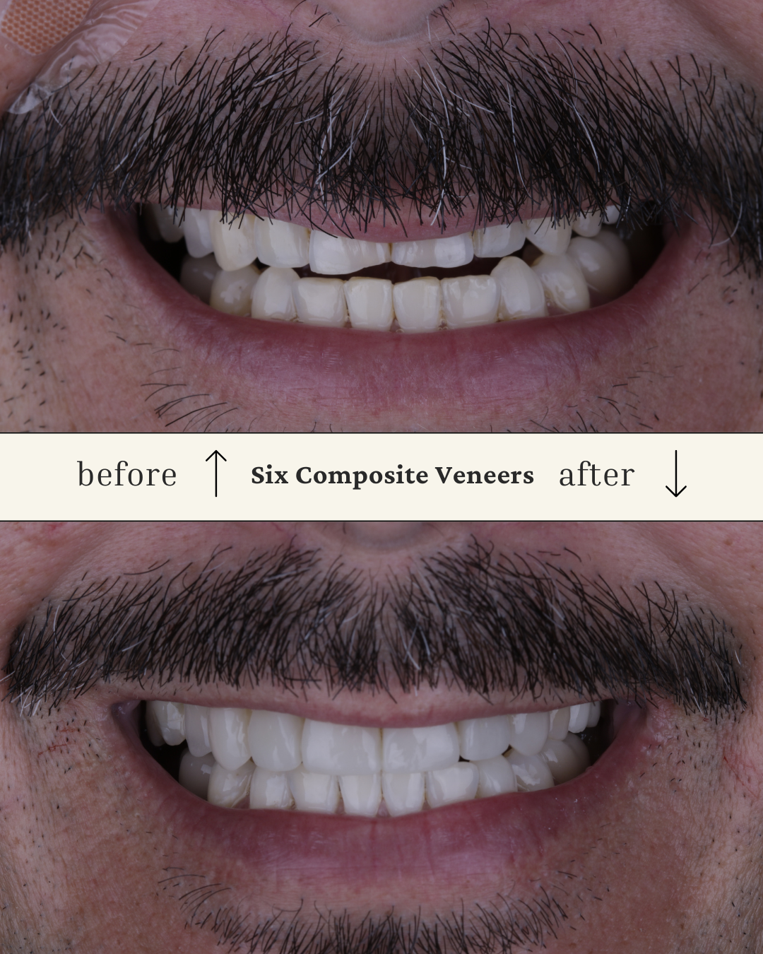 Close-up of a man's smile showing before and after composite bonding, with the top image showing teeth before and the bottom image showing teeth after.