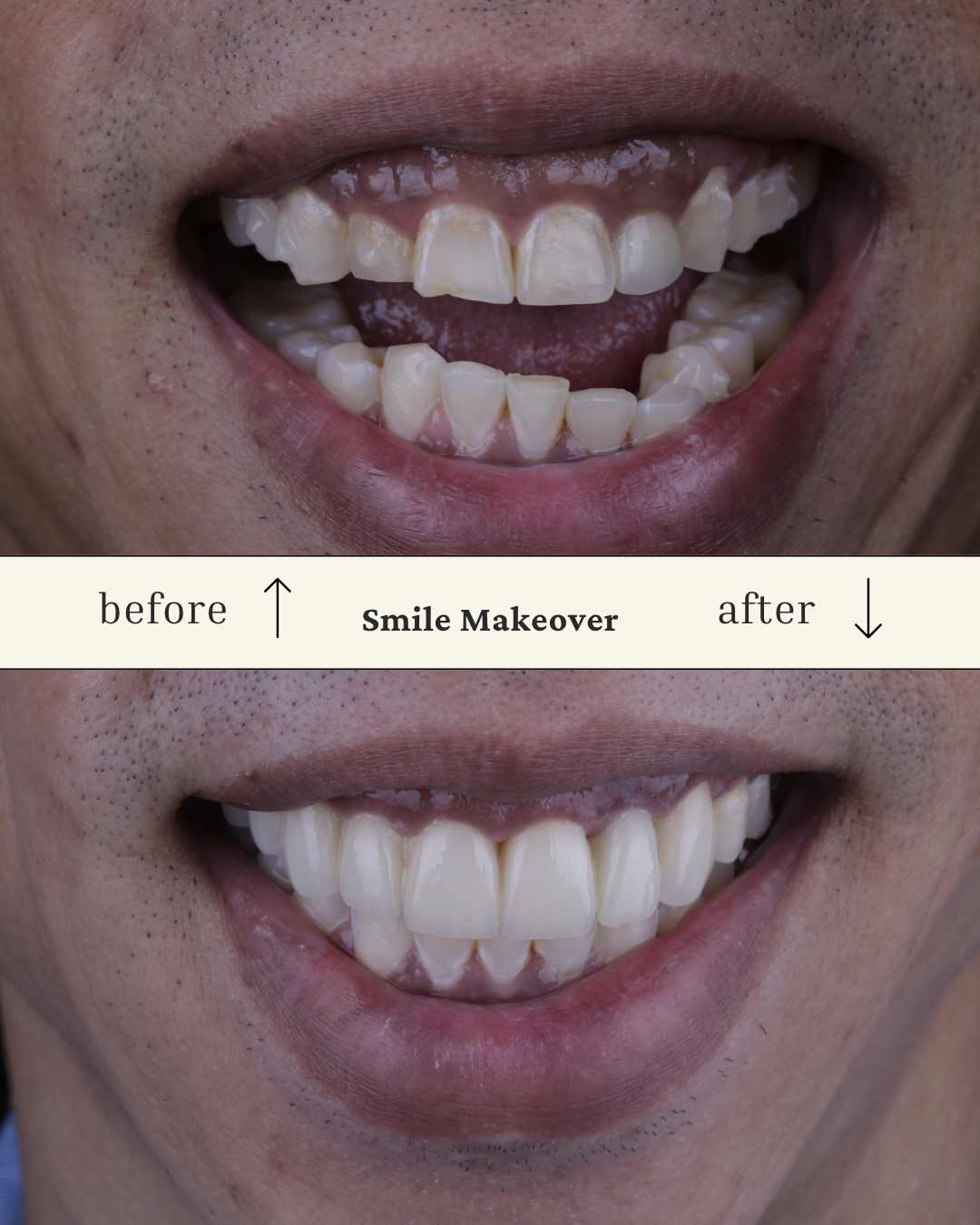 Close-up of a smiling person's teeth before and after a smile makeover, showing improved teeth alignment and whiteness.