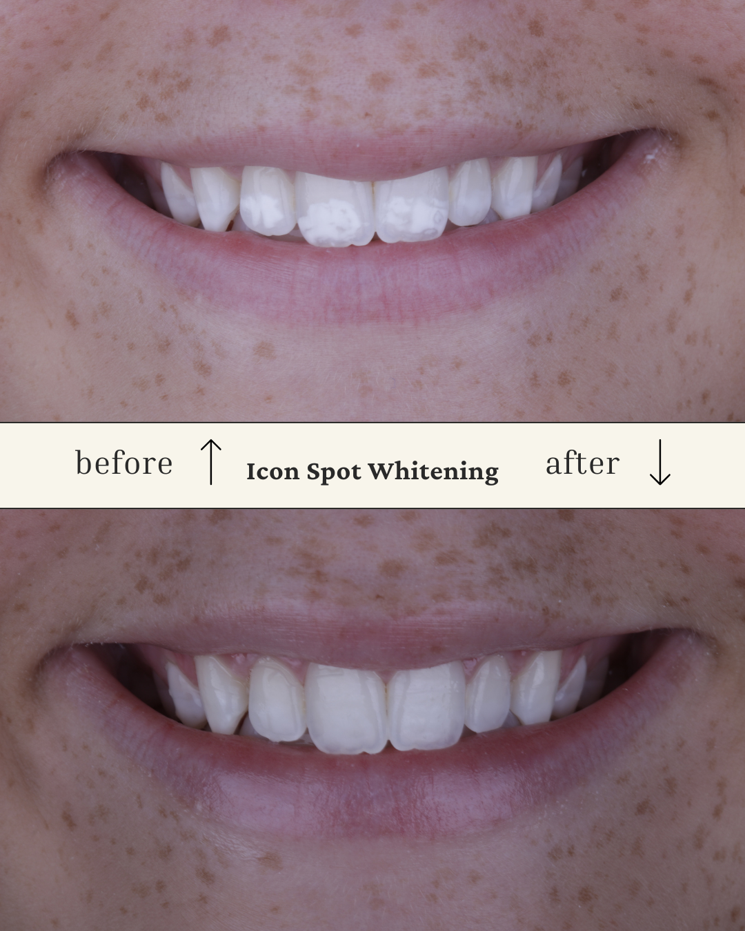Close-up of a person's smile showing teeth before and after icon spot whitening treatment, with a focus on the whitened teeth in the after image.
