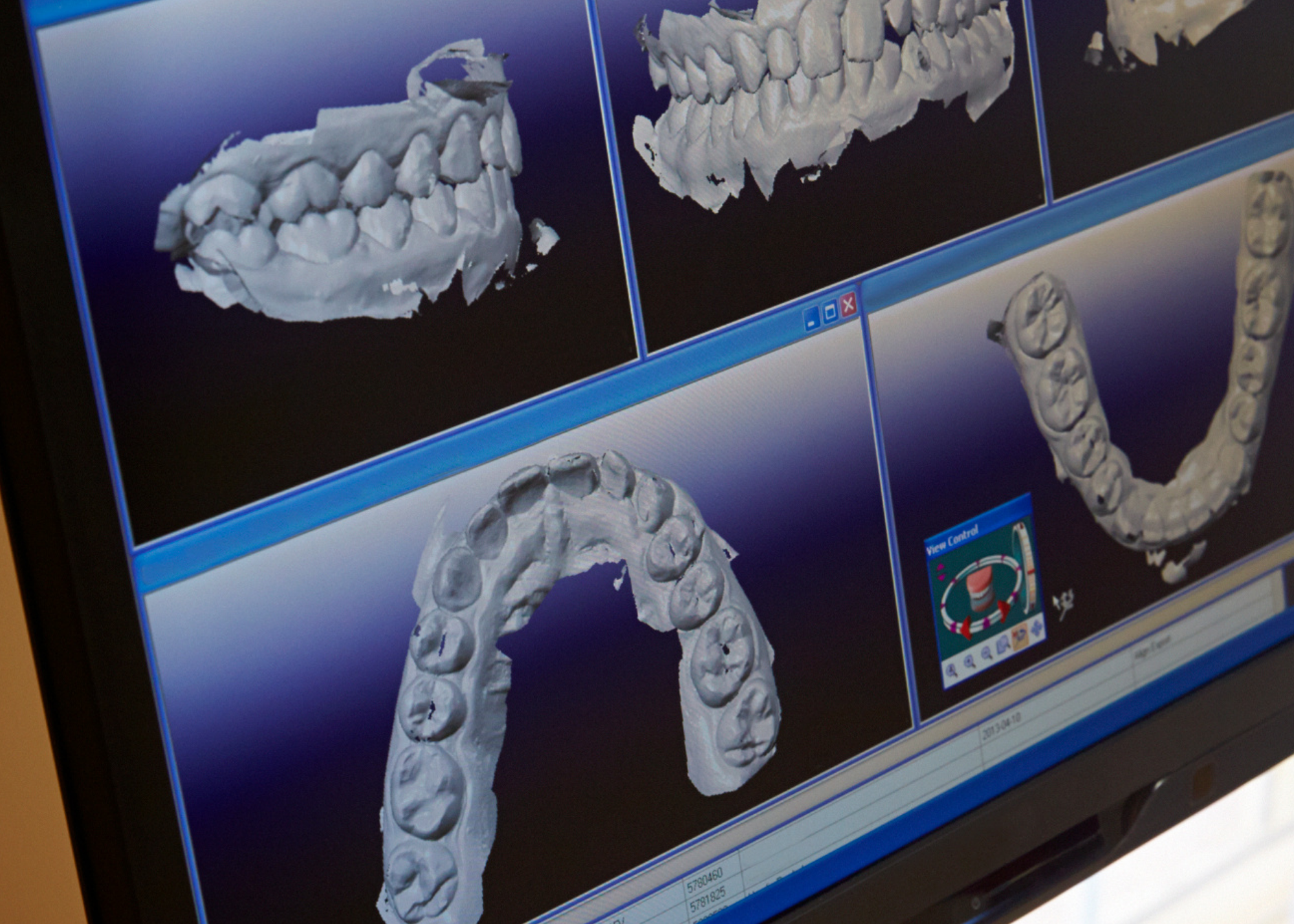 Computer screen displaying 3D digital models of teeth and dental arches.