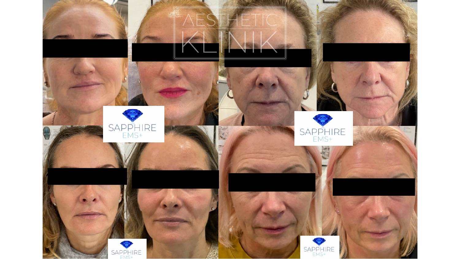 EMS before and after 4.jpg