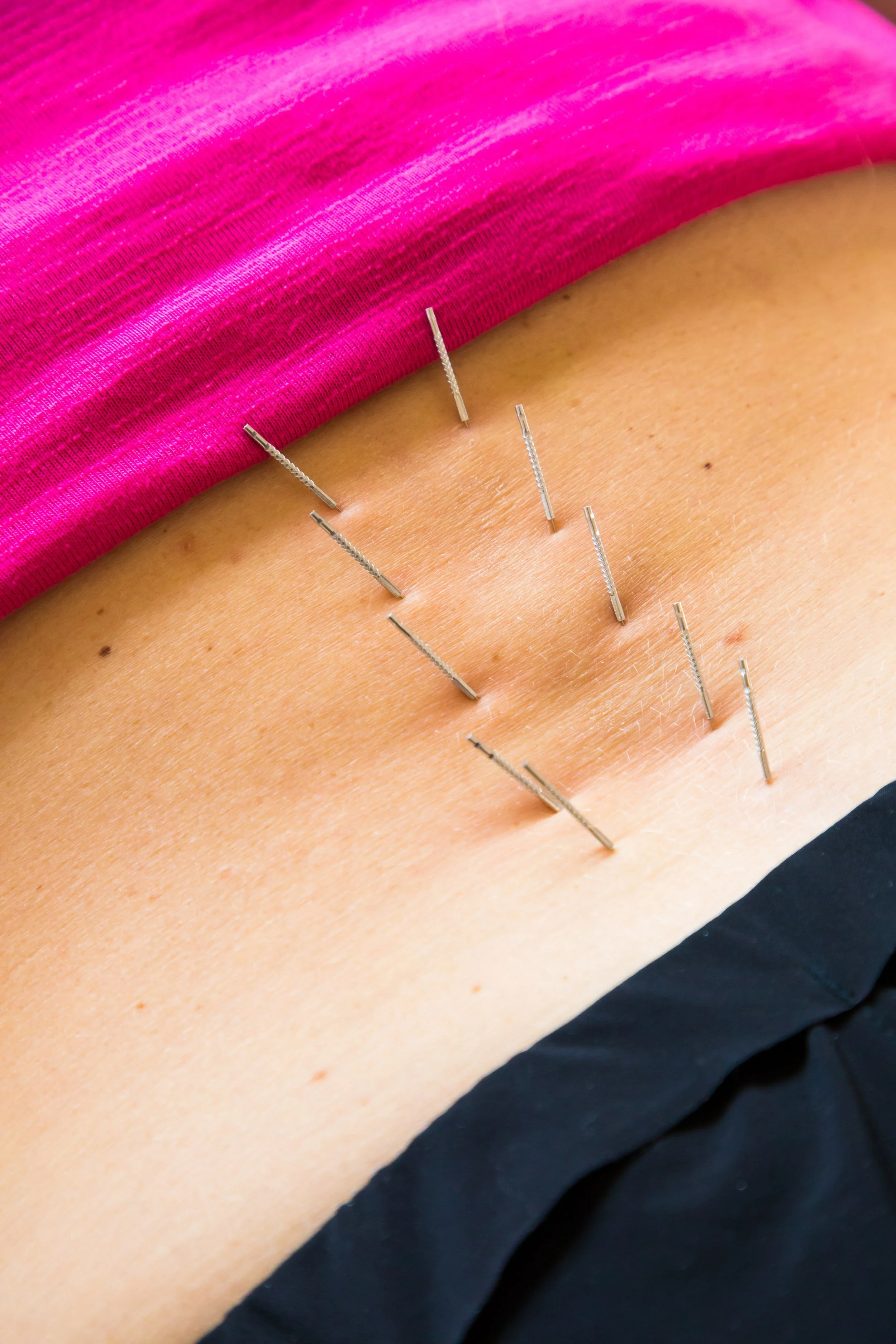 Dry Needling your back for pain, isn’t just about your back