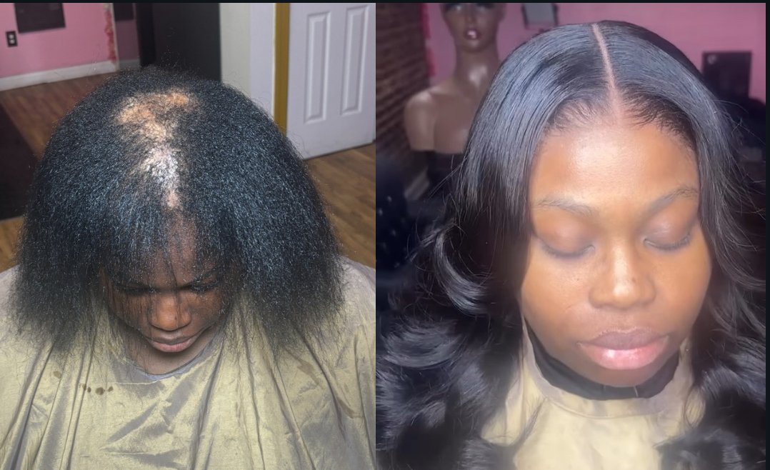 “Before and after mesh integration hair loss solution for women with bald spots”