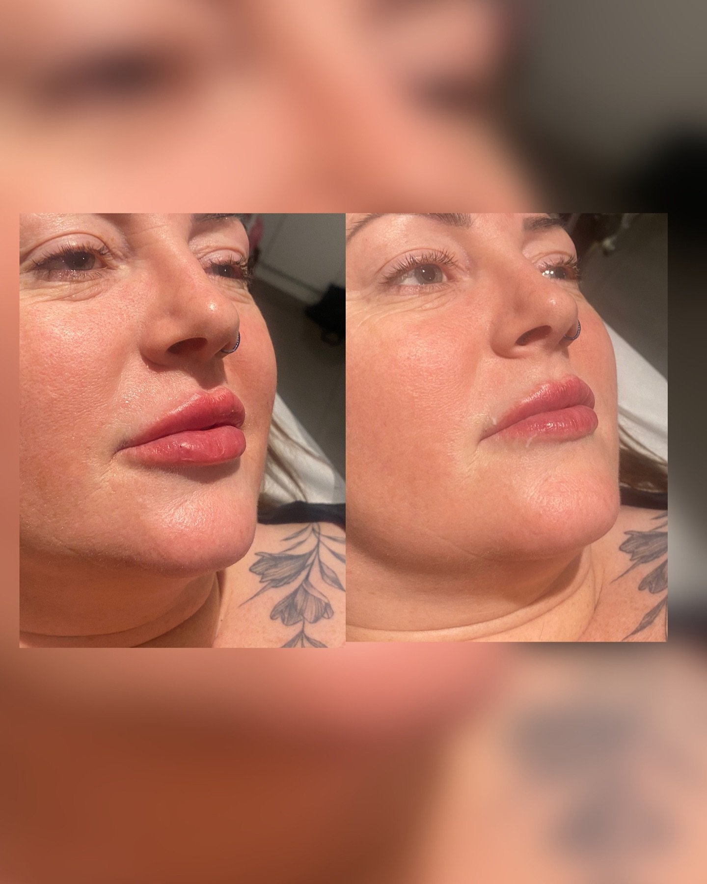 My first official client who had a bit of migration above her top lip.
✨ 1ml dermal filler
To give that full and plump look and refilled the left area for more even lips 👄
#lipenhancement #safeinjector #aesthetics