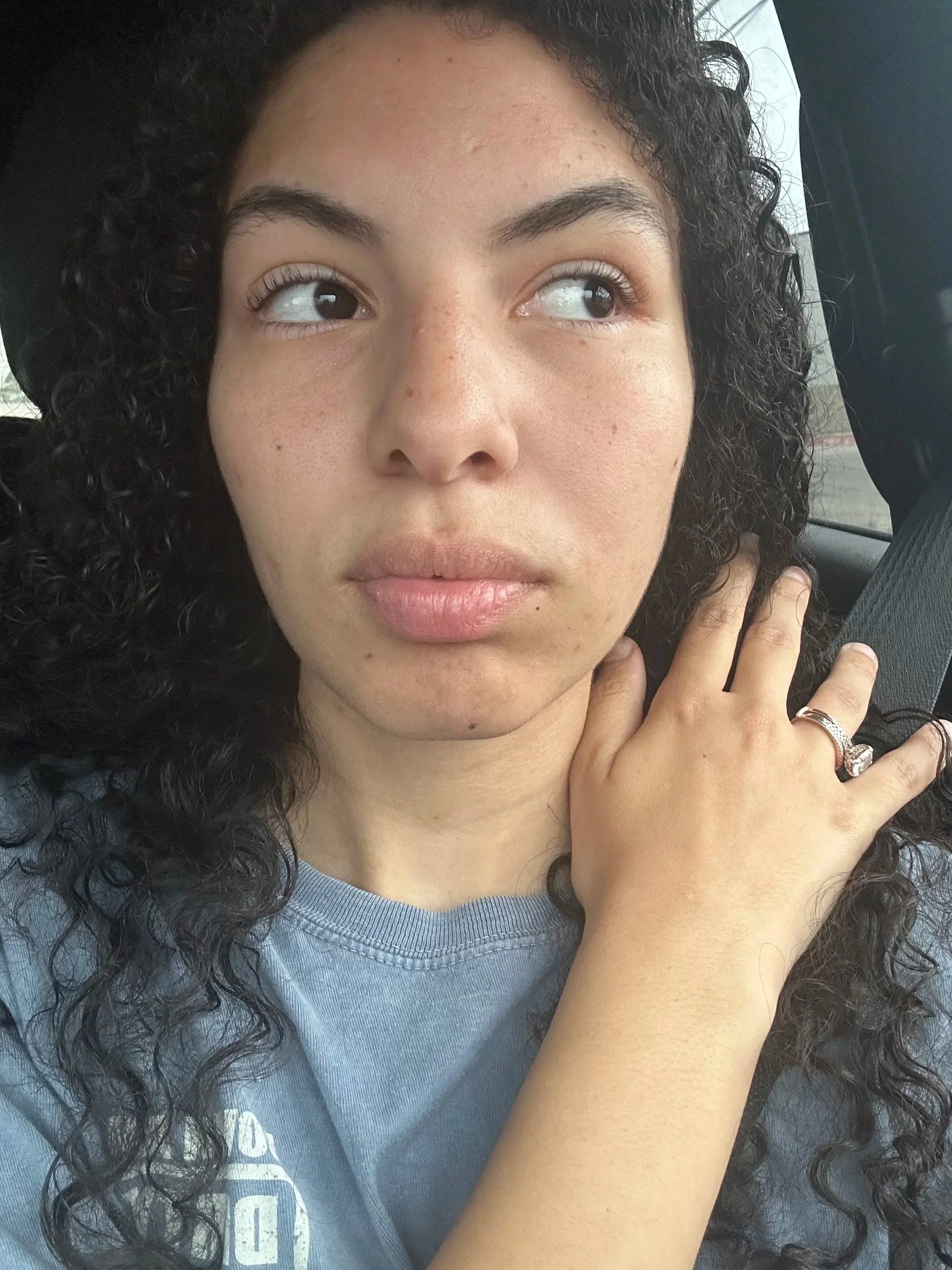 my wisdom teeth journey • why i needed oral surgery
